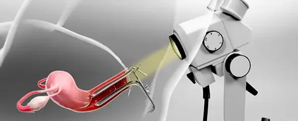 Эрозия шейки матки Эрозия шейки матки