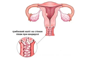 Кандидоз