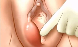 Бартолинит